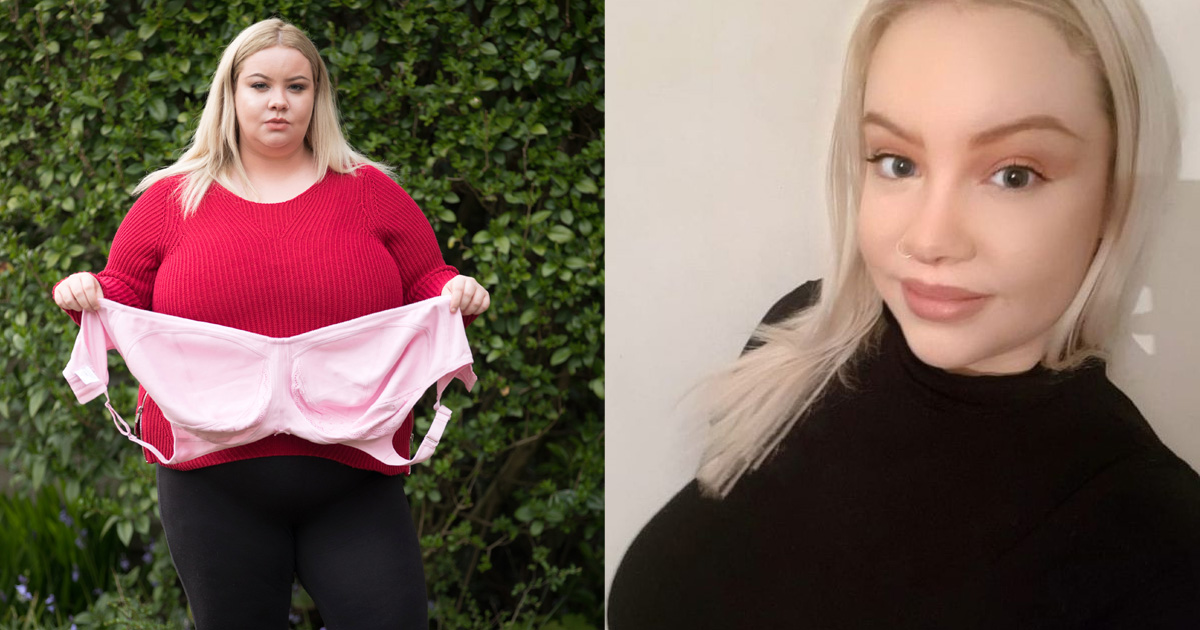 Fiona Hornby, la donna affetta da macromastia e la sua metamorfosi