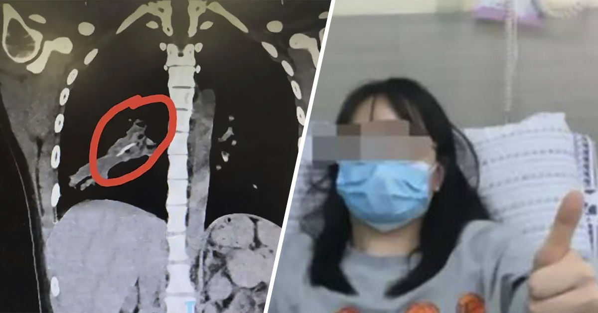 Tosse persistente: donna scopre di avere un osso di pollo incastrato in un polmone da 14 anni