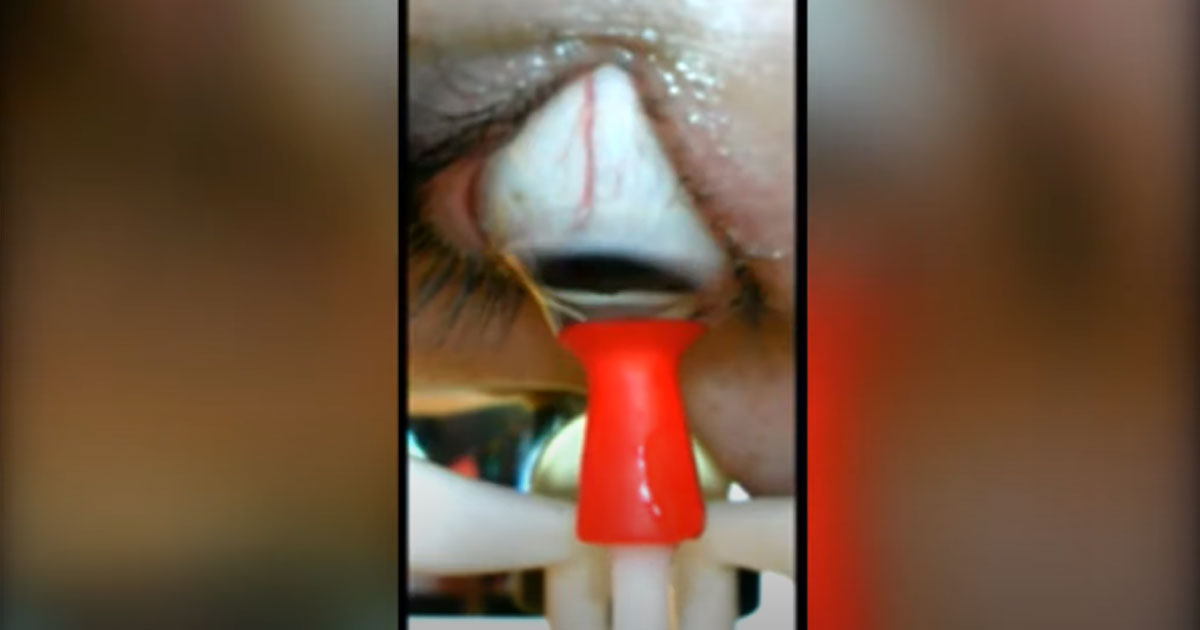 Florida, inventa un robot per inserire e rimuovere le lenti a contatto [+VIDEO]