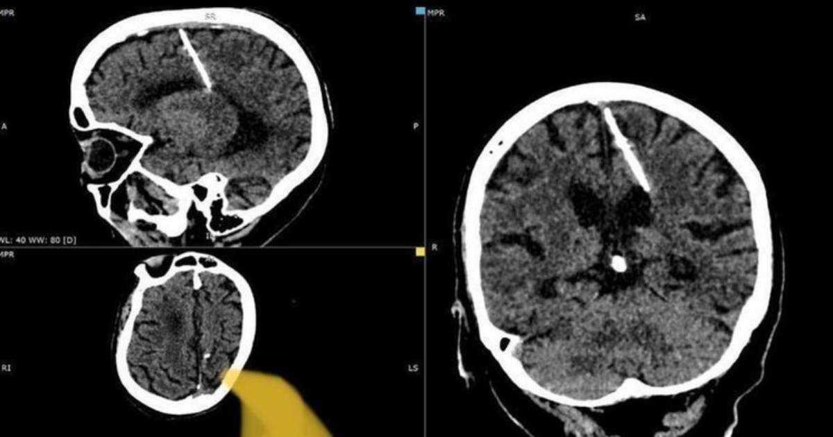 Una donna di 80 anni scopre di aver vissuto con un ago di metallo nel cervello per tutta la vita
