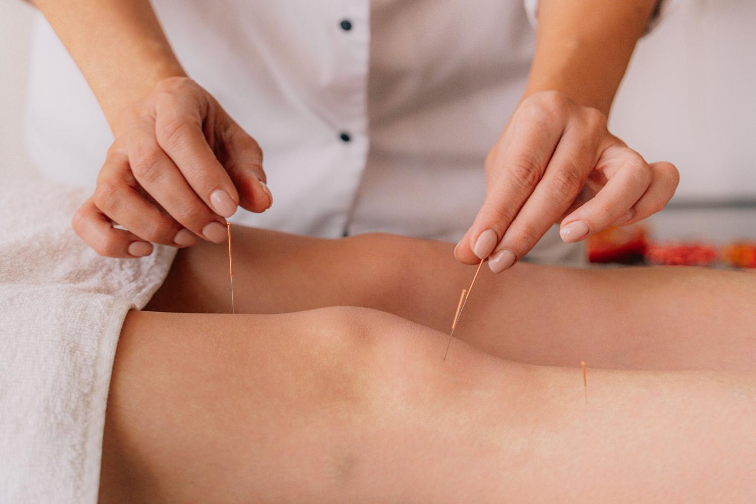 Agopuntura da incubo: va per curare il dolore e ne esce con dieci aghi rotti nella gamba